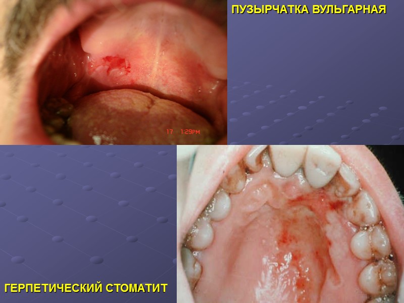 ПУЗЫРЧАТКА ВУЛЬГАРНАЯ ГЕРПЕТИЧЕСКИЙ СТОМАТИТ